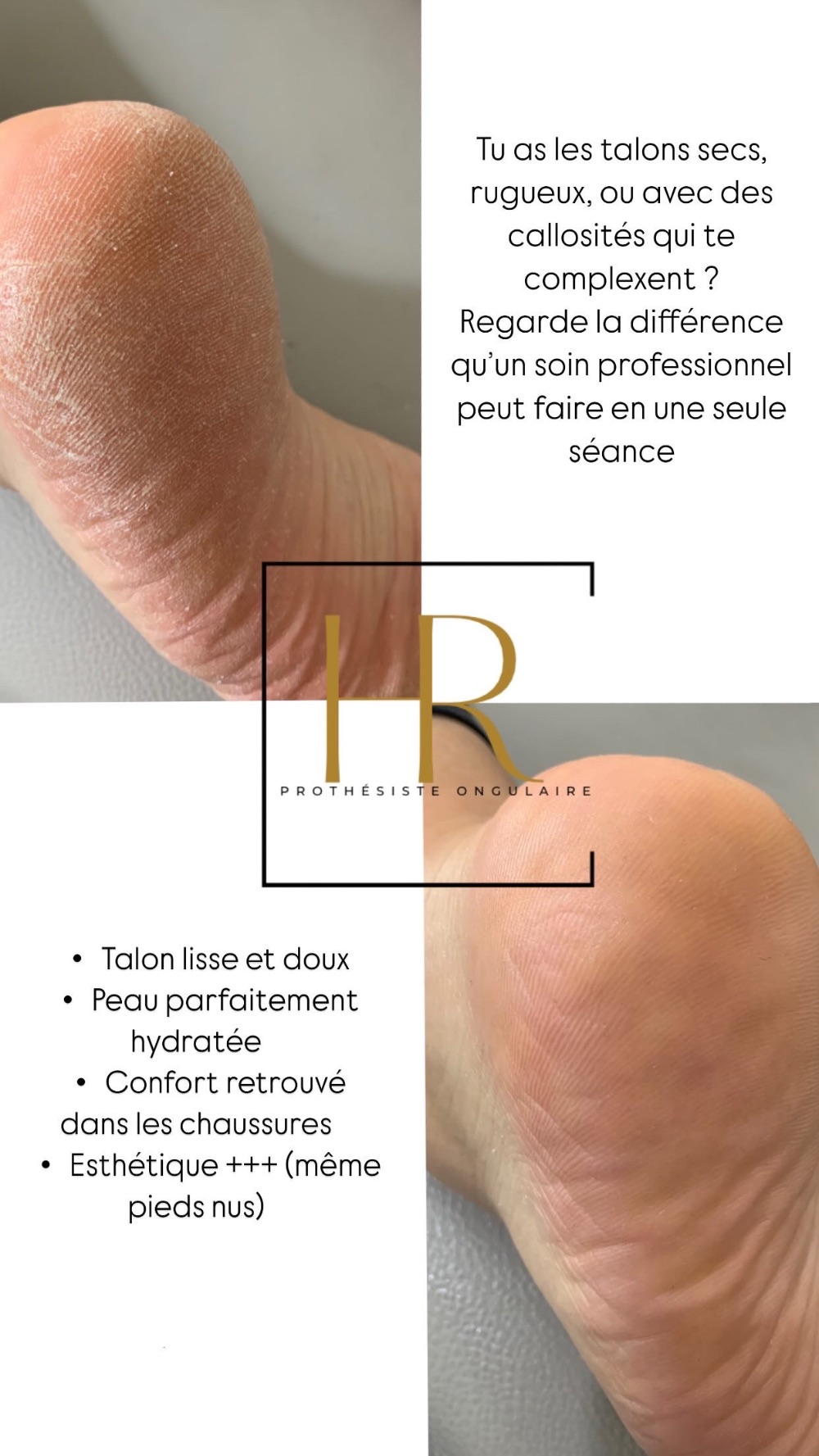 Préparez vos pieds pour les beaux jours : le soin indispensable de la saison
